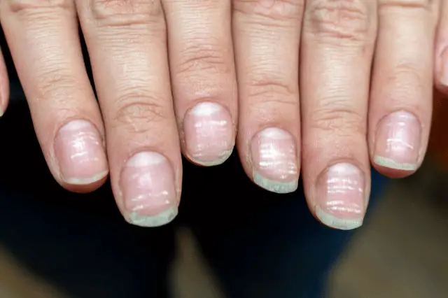 How to Prevent Discoloration of the Fingernail Bed