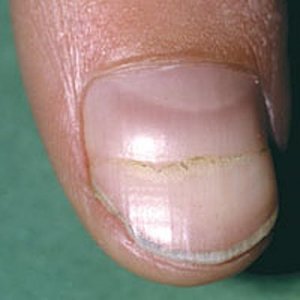 White Fingernail Beds – What It Means – Get Long Nails