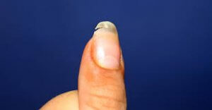 Fingernails Keep Splitting