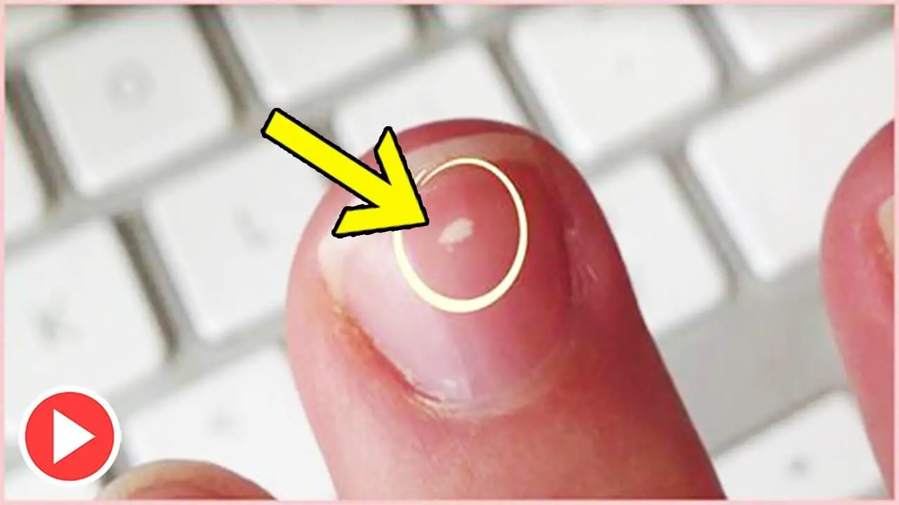 How To Get Rid Of White Spots On My Nails