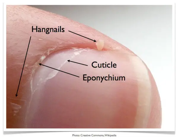 overgrown-cuticles-causes-how-to-get-rid-of-it-painlessly-get