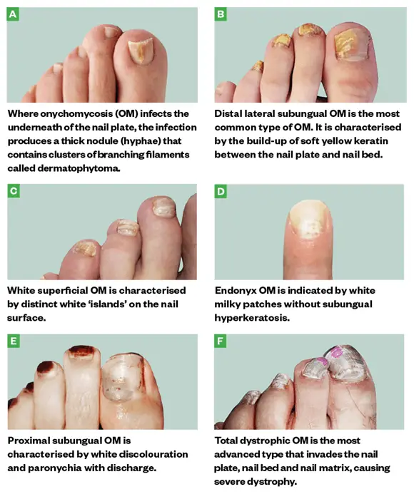 How Long Does Toenail Trauma Take To Heal