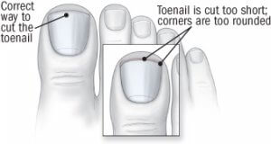 How To Get Toenails To Grow Straight 
