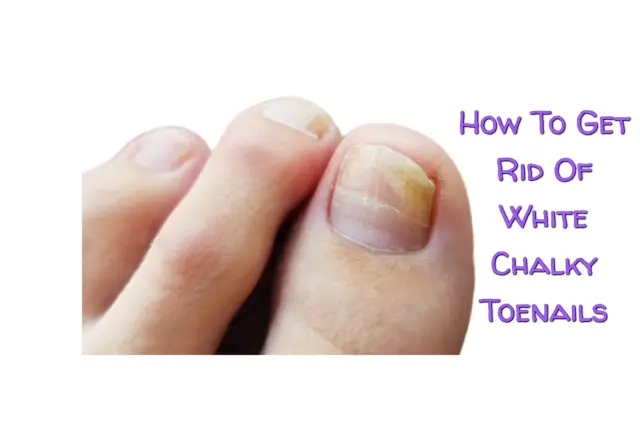 How To Get Rid Of White Chalky Toenails